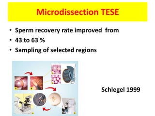 Microdissection TESE
• Sperm recovery rate improved from
• 43 to 63 %
• Sampling of selected regions
Schlegel 1999
 