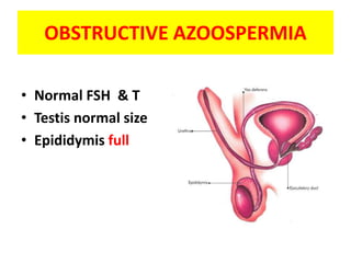 OBSTRUCTIVE AZOOSPERMIA
• Normal FSH & T
• Testis normal size
• Epididymis full
 