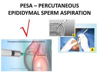 PESA – PERCUTANEOUS
EPIDIDYMAL SPERM ASPIRATION
√
 