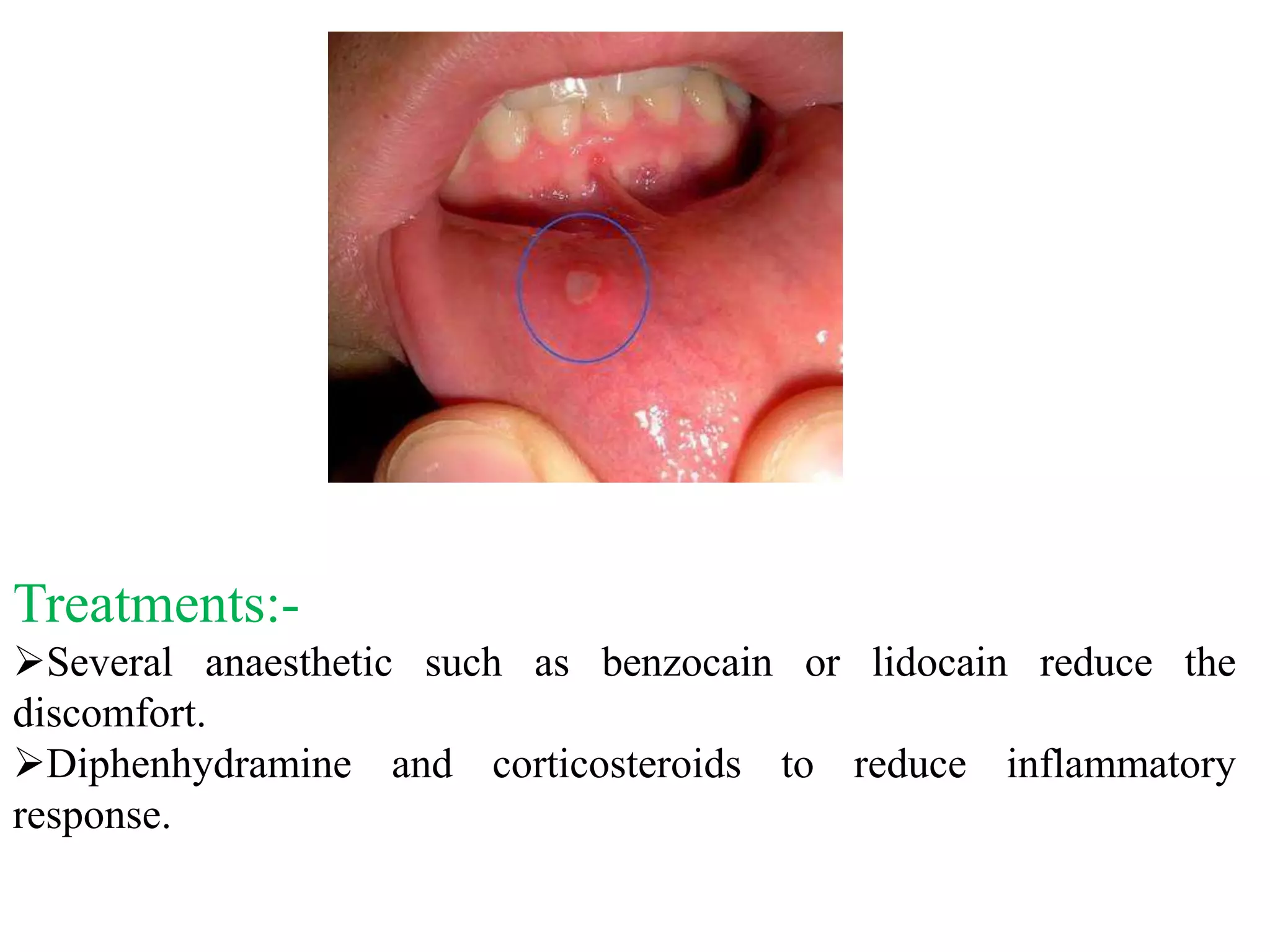 Treatments:-
Several anaesthetic such as benzocain or lidocain reduce the
discomfort.
Diphenhydramine and corticosteroids to reduce inflammatory
response.
 
