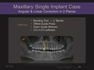 Maxillary Single Implant Case
               Angular & Linear Correction in 2 Planes

                              Bending Tool ► 2 Bends
              Featuring:      Offset Guide Posts
                              Open Guide Sleeves
                              GALAXIS software


                  #7




MAY 2.2013
 
