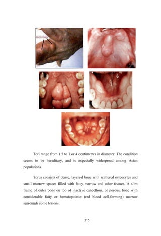 215
Tori range from 1.5 to 3 or 4 centimetres in diameter. The condition
seems to be hereditary, and is especially widespread among Asian
populations.
Torus consists of dense, layered bone with scattered osteocytes and
small marrow spaces filled with fatty marrow and other tissues. A slim
frame of outer bone on top of inactive cancellous, or porous, bone with
considerable fatty or hematopoietic (red blood cell-forming) marrow
surrounds some lesions.
 