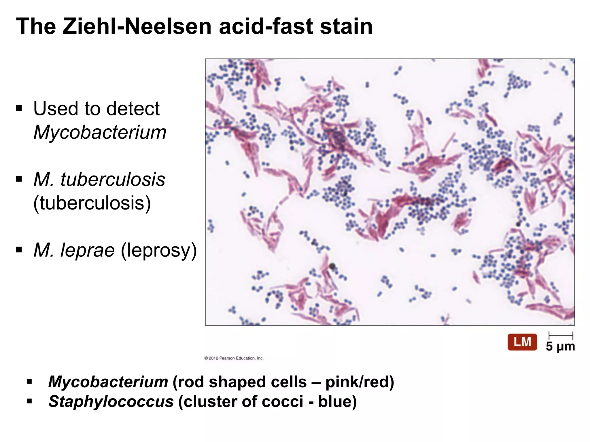 The Ziehl-Neelsen acid-fast stain
 Mycobacterium (rod shaped cells – pink/red)
 Staphylococcus (cluster of cocci - blue)
 Used to detect
Mycobacterium
 M. tuberculosis
(tuberculosis)
 M. leprae (leprosy)
 