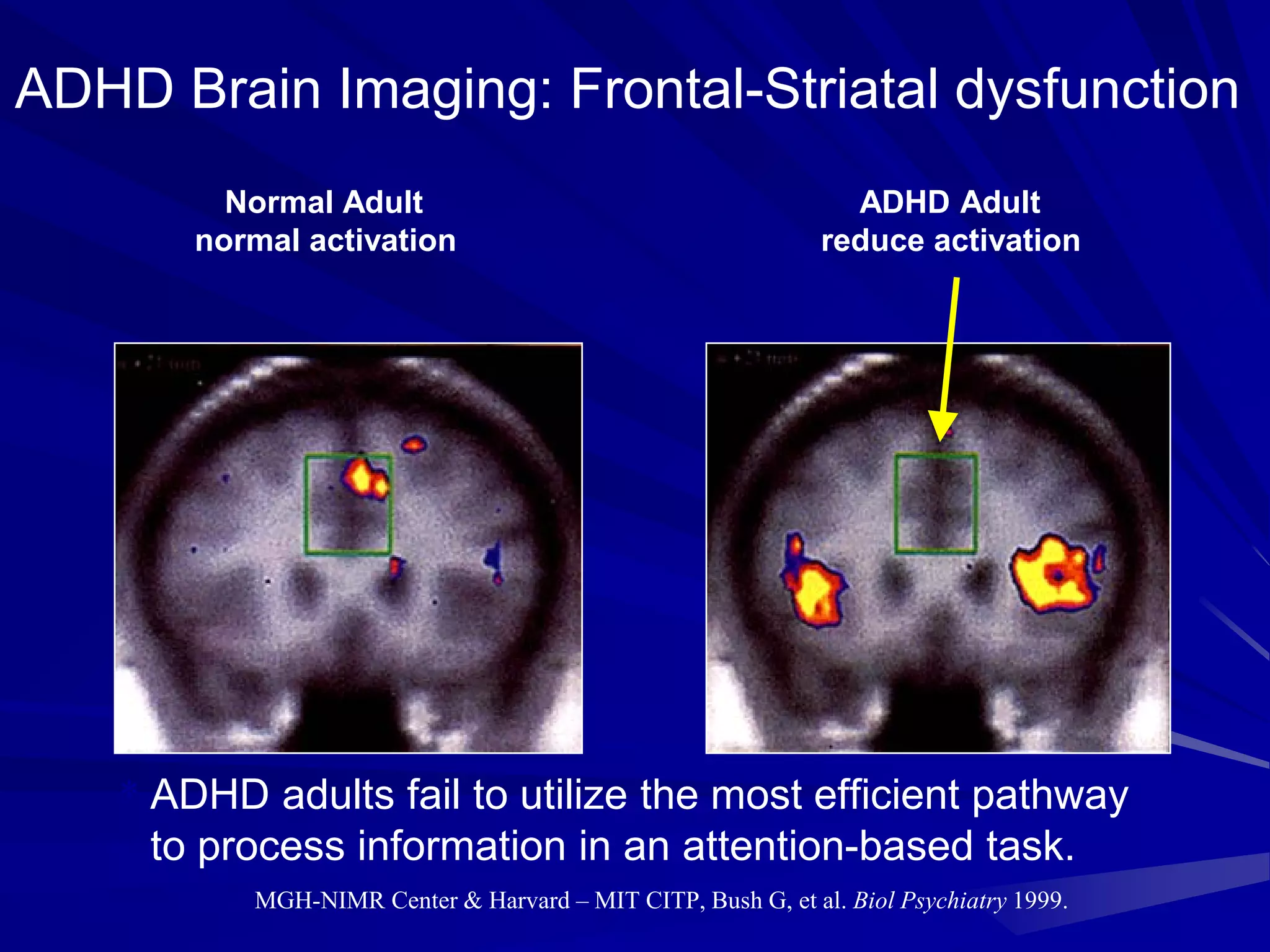 ADHD Brain Imaging: Frontal-Striatal dysfunction
Normal Adult ADHD Adult
normal activation reduce activation
* ADHD adults fail to utilize the most efficient pathway
to process information in an attention-based task.
MGH-NIMR Center & Harvard – MIT CITP, Bush G, et al. Biol Psychiatry 1999.
 