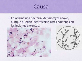 Causa
• Lo origina una bacteria: Actimomyces bovis,
aunque pueden identificarse otras bacterias en
las lesiones extensas.
 