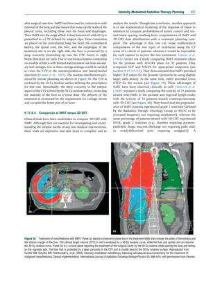 IMRT | PDF