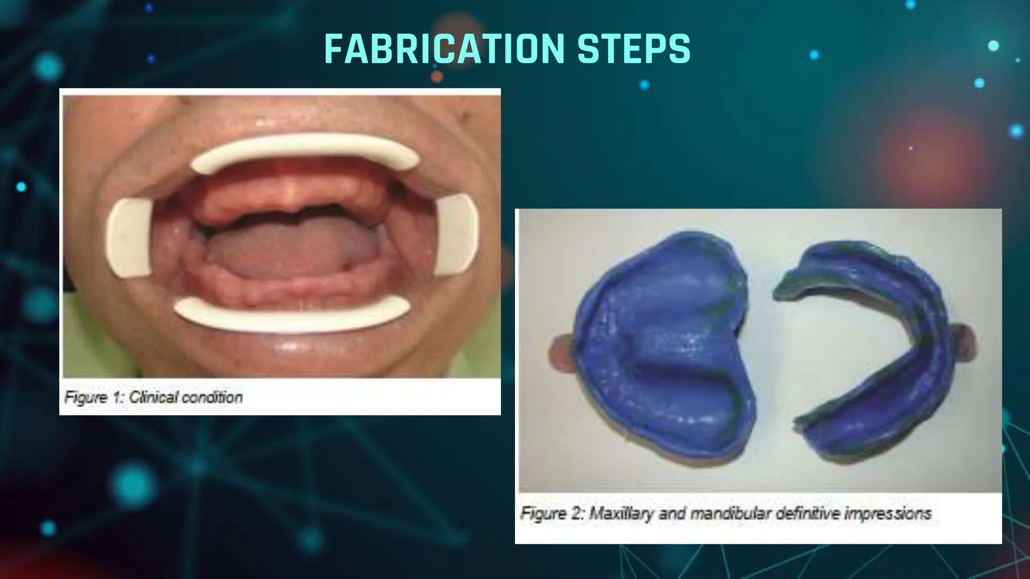 CAD CAM DENTURES IN PROSTHODONTICS : Dental advancements | PPTX