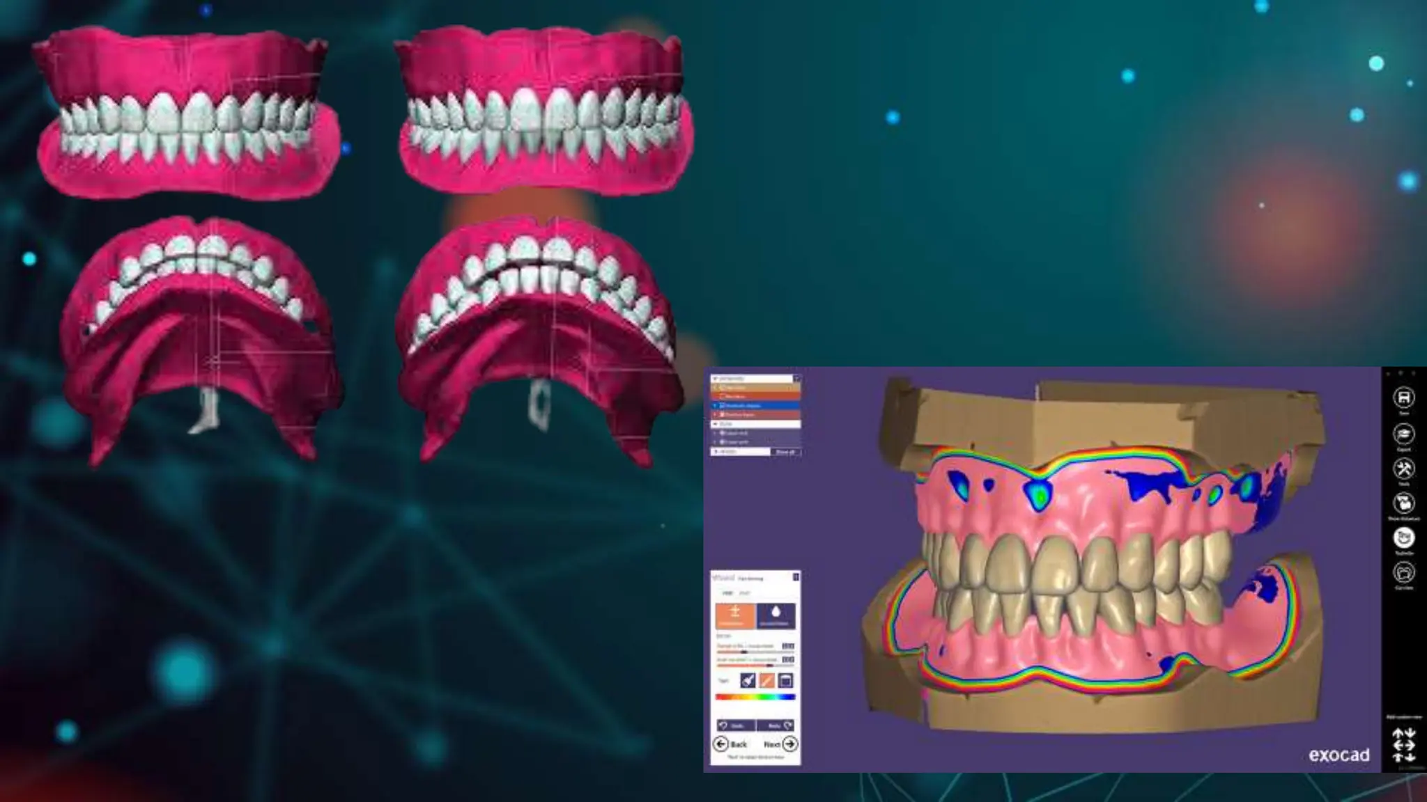 CAD CAM DENTURES IN PROSTHODONTICS : Dental advancements | PPTX