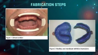 CAD CAM DENTURES IN PROSTHODONTICS : Dental advancements | PPTX