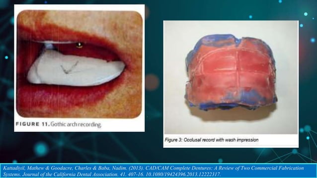 CAD CAM DENTURES IN PROSTHODONTICS : Dental advancements | PPTX ...