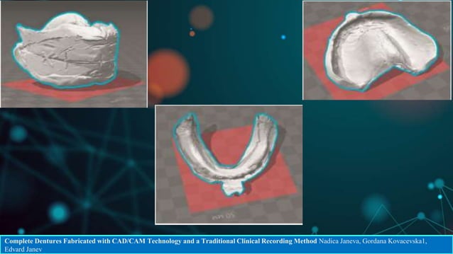 CAD CAM DENTURES IN PROSTHODONTICS : Dental advancements | PPTX ...