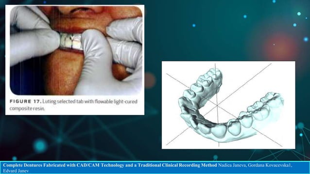 CAD CAM DENTURES IN PROSTHODONTICS : Dental advancements | PPTX ...