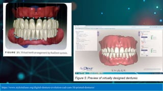 CAD CAM DENTURES IN PROSTHODONTICS : Dental advancements | PPTX