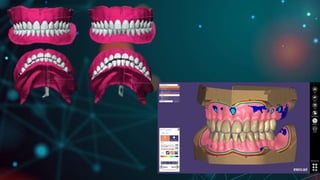 CAD CAM DENTURES IN PROSTHODONTICS : Dental advancements | PPTX