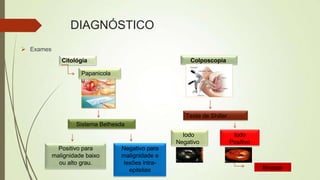 DIAGNÓSTICO
 Exames
Citológia
Papanicola
u
Sistema Bethesda
Negativo para
malignidade e
lesões intra-
epitelias
Positivo para
malignidade baixo
ou alto grau.
Colposcopia
Teste de Shiller
Iodo
Negativo
Iodo
Positivo
Biopsia
 
