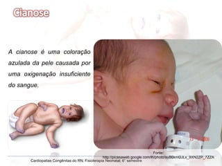Cardiopatias Congênitas do RN; Fisioterapia Neonatal; 6° semestre A cianose é uma coloração azulada da pele causada por uma oxigenação insuficiente do sangue. Fonte: http://picasaweb.google.com/lh/photo/ayB0kmUJLx_9XN2ZP_7ZZA 