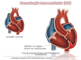 Cardiopatias Congênitas do RN; Fisioterapia Neonatal; 6° semestre Fonte: http://coracao2010.blogspot.com/2010/02/comunicacao-interventricular.html 