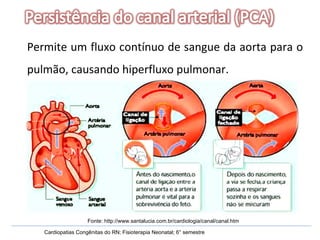 Permite um fluxo contínuo de sangue da aorta para o pulmão, causando hiperfluxo pulmonar. Cardiopatias Congênitas do RN; Fisioterapia Neonatal; 6° semestre Fonte: http://www.santalucia.com.br/cardiologia/canal/canal.htm 
