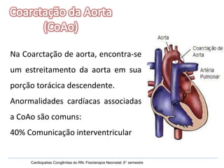 Cardiopatias Congênitas do RN; Fisioterapia Neonatal; 6° semestre Na Coarctação de aorta, encontra-se um estreitamento da aorta em sua porção torácica descendente.  Anormalidades cardíacas associadas a CoAo são comuns: 40% Comunicação interventricular 