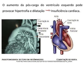 O aumento da pós-carga do ventrículo esquerdo pode provocar hipertrofia e dilatação  Insuficiência cardíaca.  Fonte:http://www.scielo.br/scielo.php?pid=S0102-76382007000200005&script=sci_arttext 