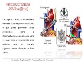 Em alguns casos, a necessidade de instalação de prótese valvular, o que pode provocar sérios problemas para o desenvolvimento da criança, uma vez que com o crescimento essa prótese deve ser trocada algumas vezes durante a fase adulta. Cardiopatias Congênitas do RN; Fisioterapia Neonatal; 6° semestre 