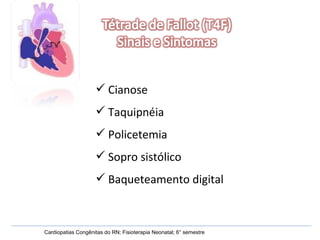 Cardiopatias Congênitas do RN; Fisioterapia Neonatal; 6° semestre Cianose Taquipnéia Policetemia Sopro sistólico Baqueteamento digital 