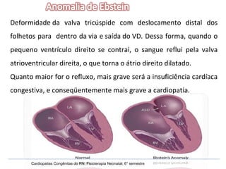 Deformidade da valva tricúspide com deslocamento distal dos folhetos para  dentro da via e saída do VD. Dessa forma, quando o pequeno ventrículo direito se contrai, o sangue reflui pela valva atrioventricular direita, o que torna o átrio direito dilatado. Quanto maior for o refluxo, mais grave será a insuficiência cardíaca congestiva, e conseqüentemente mais grave a cardiopatia. Cardiopatias Congênitas do RN; Fisioterapia Neonatal; 6° semestre 