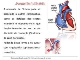 Cardiopatias Congênitas do RN; Fisioterapia Neonatal; 6° semestre A anomalia de Ebstein pode vir associada a outras cardiopatias, como os defeitos dos septos interatrial e interventricular, que freqüentemente decorre de um distúrbio de condução (Síndrome de Wolf-Parkinson). Podendo desta forma o RN cursar com taquicardia supraventricular paroxística. 