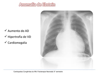 Aumento do AD Hipertrofia de VD Cardiomegalia Cardiopatias Congênitas do RN; Fisioterapia Neonatal; 6° semestre 