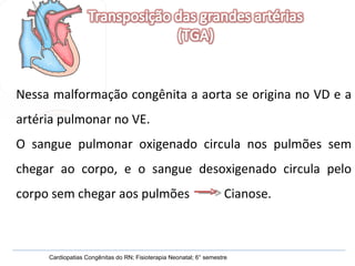 Cardiopatias Congênitas do RN; Fisioterapia Neonatal; 6° semestre Nessa malformação congênita a aorta se origina no VD e a artéria pulmonar no VE. O sangue pulmonar oxigenado circula nos pulmões sem chegar ao corpo, e o sangue desoxigenado circula pelo corpo sem chegar aos pulmões  Cianose. 