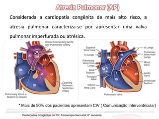 Cardiopatias Congênitas do RN; Fisioterapia Neonatal; 6° semestre Considerada a cardiopatia congênita de mais alto risco, a atresia pulmonar caracteriza-se por apresentar uma valva pulmonar imperfurada ou atrésica. * Mais de 90% dos pacientes apresentam CIV ( Comunicação Interventricular) 