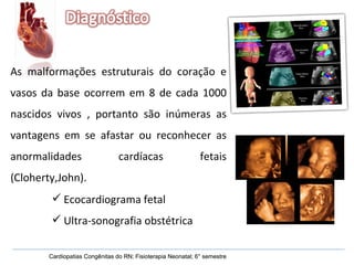 Cardiopatias Congênitas do RN; Fisioterapia Neonatal; 6° semestre Cardiopatias Congênitas do RN; Fisioterapia Neonatal; 6° semestre Ecocardiograma fetal  Ultra-sonografia obstétrica As malformações estruturais do coração e vasos da base ocorrem em 8 de cada 1000 nascidos vivos , portanto são inúmeras as vantagens em se afastar ou reconhecer as anormalidades cardíacas fetais (Cloherty,John). 