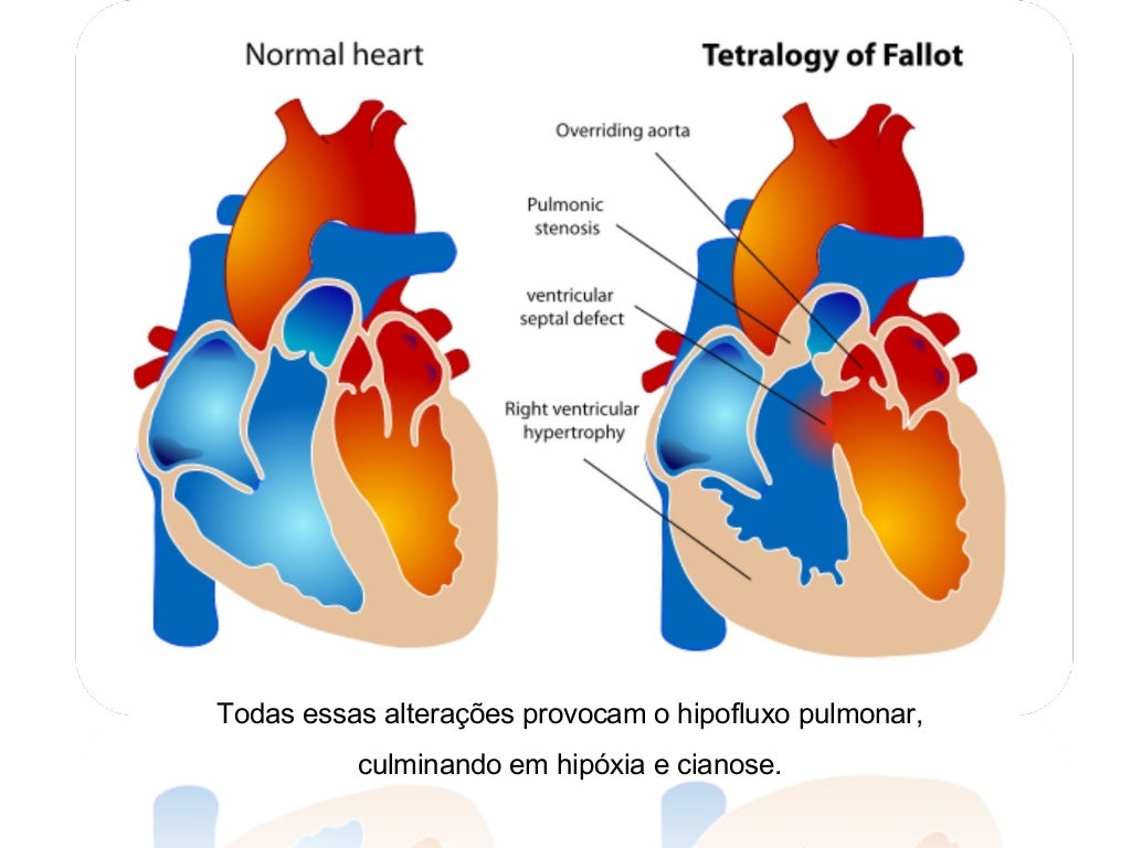 Cardiopatia Congenita Cianogena Mas Frecuente