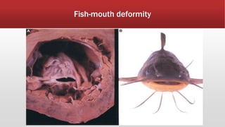 Fish-mouth deformity
 