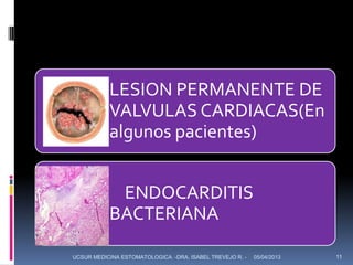 LESION PERMANENTE DE
           VALVULAS CARDIACAS(En
           algunos pacientes)


            ENDOCARDITIS
           BACTERIANA

UCSUR MEDICINA ESTOMATOLOGICA -DRA. ISABEL TREVEJO R. -   05/04/2013   11
 