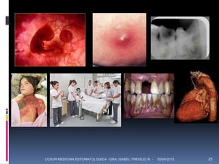 UCSUR MEDICINA ESTOMATOLOGICA -DRA. ISABEL TREVEJO R. -   05/04/2013   25
 