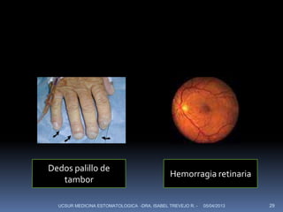Dedos palillo de
                                              Hemorragia retinaria
   tambor

  UCSUR MEDICINA ESTOMATOLOGICA -DRA. ISABEL TREVEJO R. -   05/04/2013   29
 