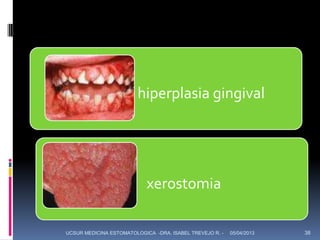 •             hiperplasia gingival




             •              xerostomia

UCSUR MEDICINA ESTOMATOLOGICA -DRA. ISABEL TREVEJO R. -   05/04/2013   38
 