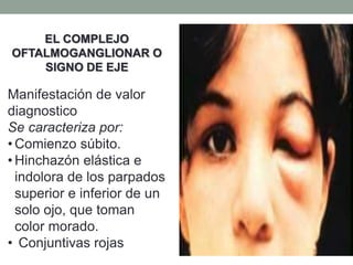EL COMPLEJO
OFTALMOGANGLIONAR O
SIGNO DE EJE
Manifestación de valor
diagnostico
Se caracteriza por:
• Comienzo súbito.
• Hinchazón elástica e
indolora de los parpados
superior e inferior de un
solo ojo, que toman
color morado.
• Conjuntivas rojas
 