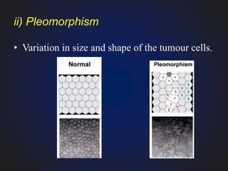 Define Pleomorphic characteristic features of tumours | PPTX