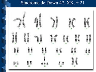 Síndrome de Down 47, XX, + 21
 