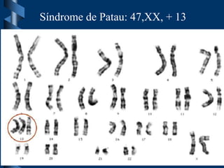 Síndrome de Patau: 47,XX, + 13
 