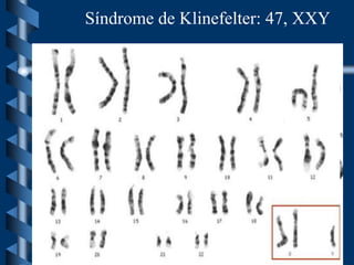 Síndrome de Klinefelter: 47, XXY
 