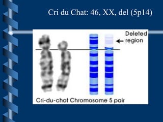 Cri du Chat: 46, XX, del (5p14)
 