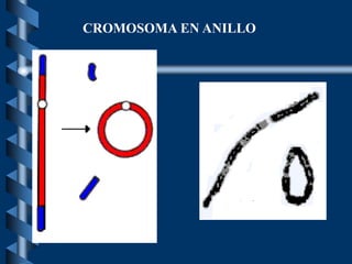 CROMOSOMA EN ANILLO
 