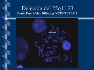 Deleción del 22q11.23
Sonda Dual Color DiGeorge/VCFS TUPLE 1
 