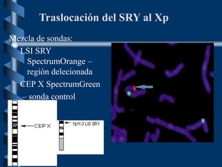 Traslocación del SRY al Xp
Mezcla de sondas:
LSI SRY
SpectrumOrange –
región delecionada
CEP X SpectrumGreen
– sonda control
 