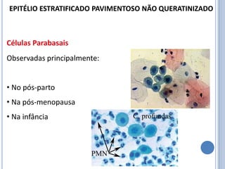 Células Parabasais
Observadas principalmente:
• No pós-parto
• Na pós-menopausa
• Na infância
EPITÉLIO ESTRATIFICADO PAVIMENTOSO NÃO QUERATINIZADO
 