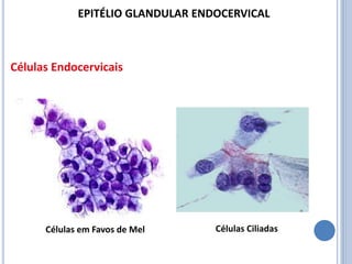 Células Endocervicais
Células em Favos de Mel Células Ciliadas
EPITÉLIO GLANDULAR ENDOCERVICAL
 