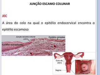 A área do colo na qual o epitélio endocervical encontra o
epitélio escamoso
JEC
JUNÇÃO ESCAMO COLUNAR
 
